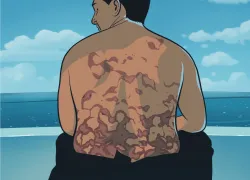 rash-illustration-stephen-p-hughes.png.webp